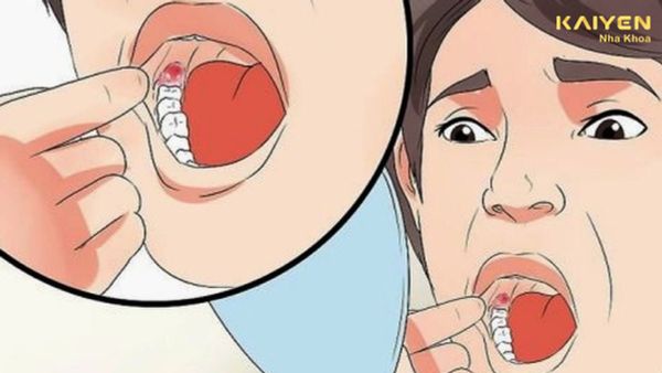 Lỗ hổng sau khi nhổ răng có sao không? Nguyên nhân và cách khắc phục