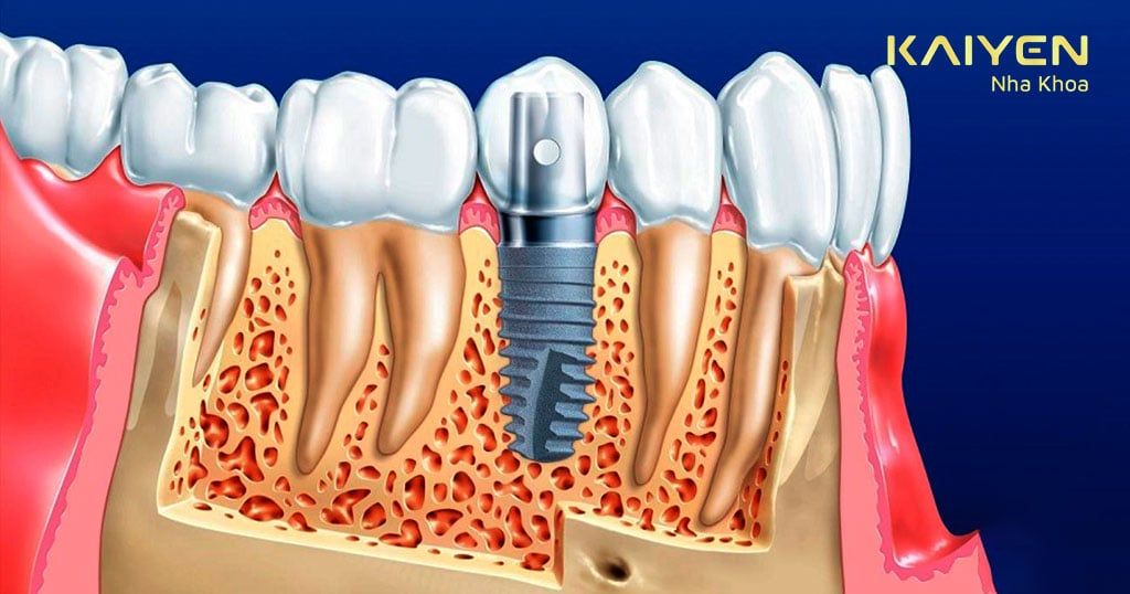Bệnh loãng xương có trồng Implant được không?