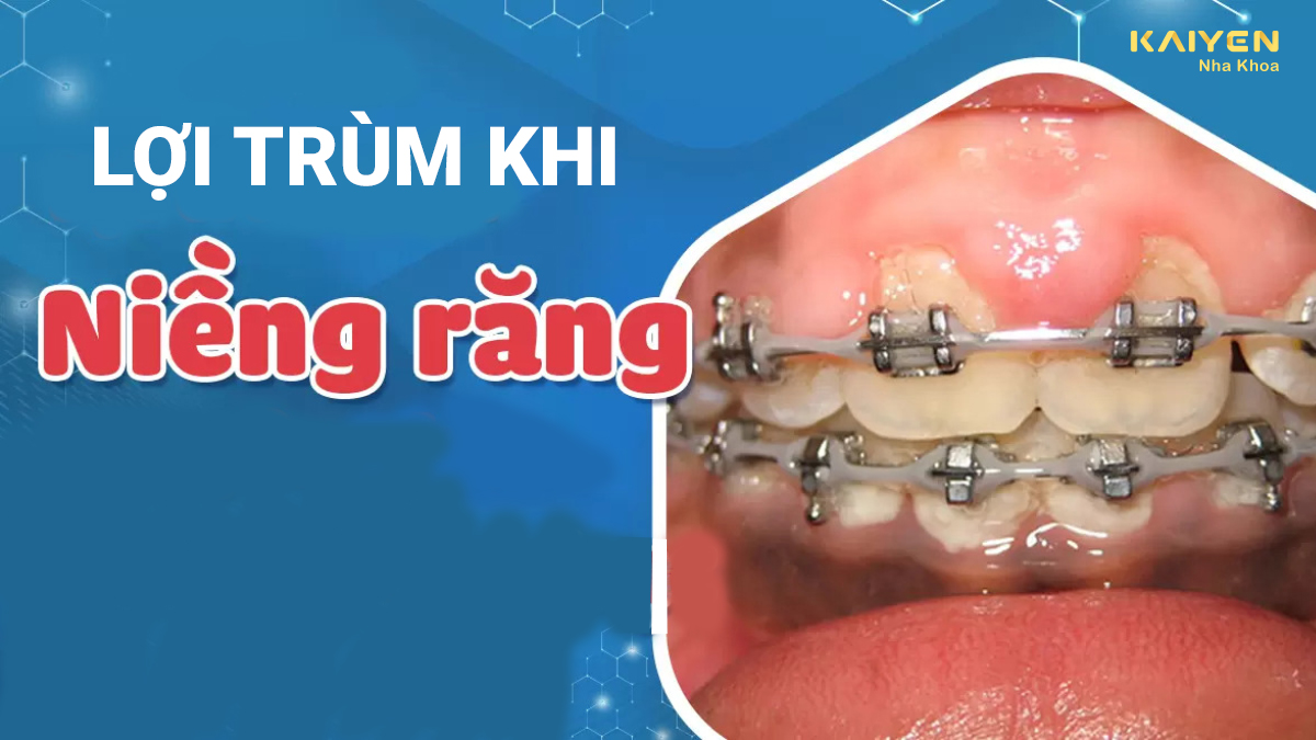 Lợi trùm khi niềng răng phải làm sao? Nguyên nhân và cách khắc phục
