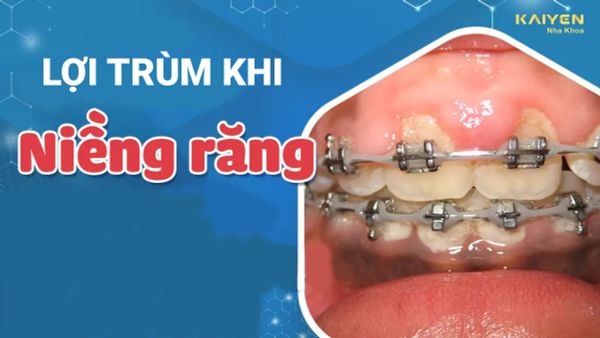 Lợi trùm khi niềng răng phải làm sao? Nguyên nhân và cách khắc phục