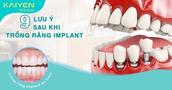 9 lưu ý sau khi trồng răng Implant nhất định bạn phải biết