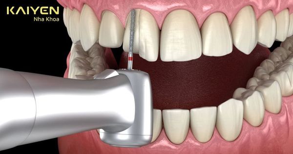 Mài răng bọc sứ có ảnh hưởng gì không? Mất thời gian bao lâu?