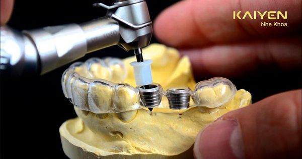 Sử dụng máng hướng dẫn phẫu thuật Implant và vai trò cụ thể