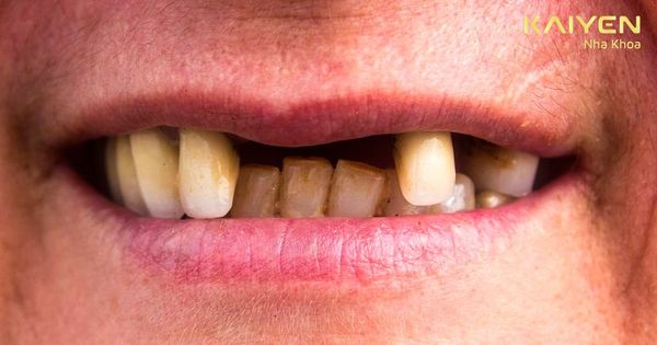 Mất 3 răng liền kề có hậu quả gì? Trồng răng loại nào phù hợp?