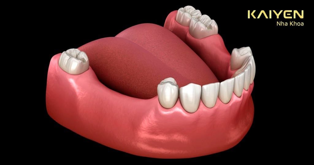 Hậu quả của việc mất 4 răng liên tiếp và phương pháp điều trị