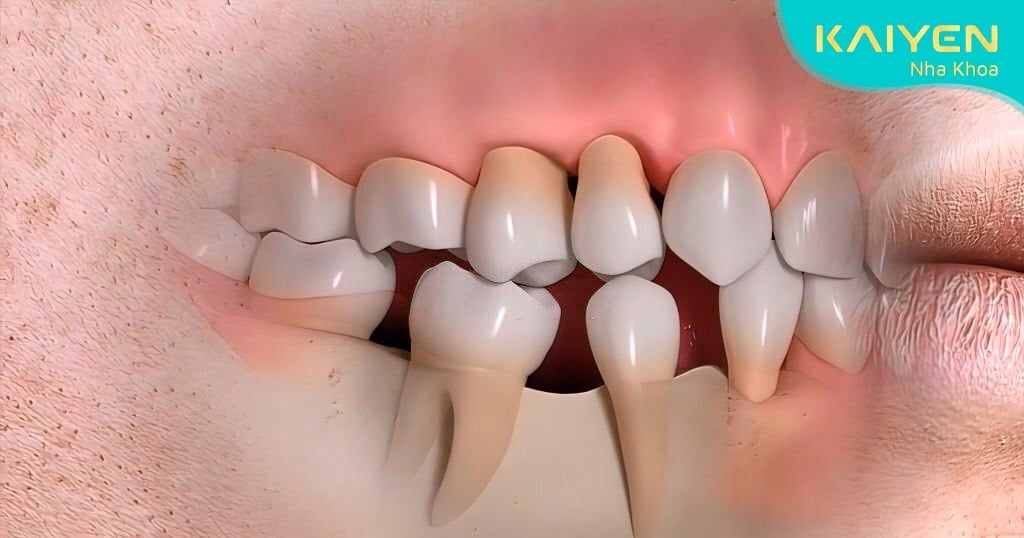 Mất nhiều răng đơn lẻ phải làm sao? Trồng lại bằng cách nào?