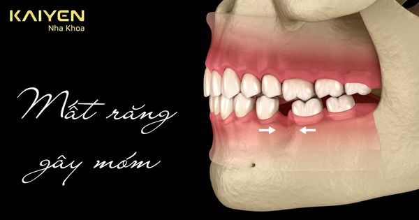 Mất răng gây móm có đúng không? Nguyên nhân và cách khắc phục