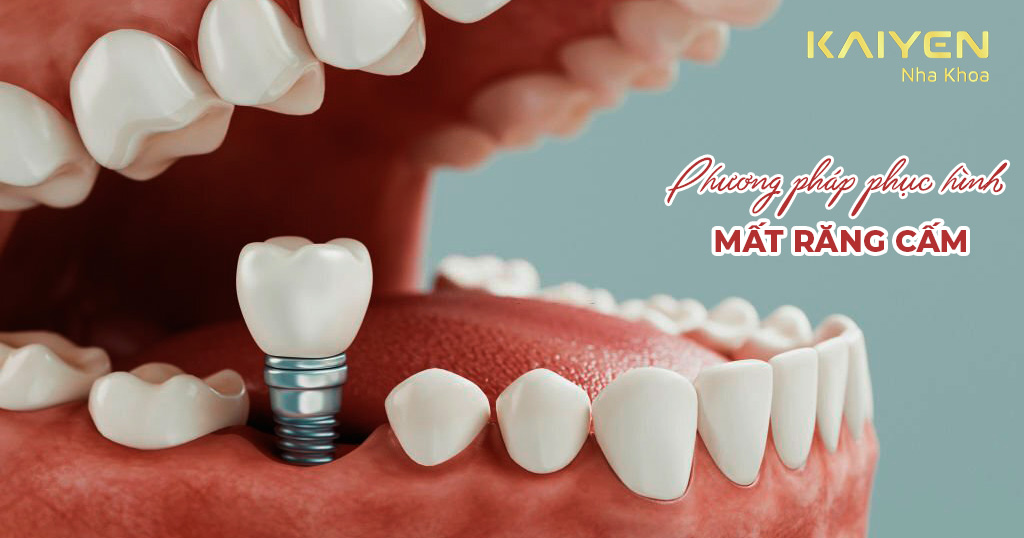 Mất răng cấm: Hậu quả, phương pháp phục hình và chi phí – Nha khoa Quốc ...