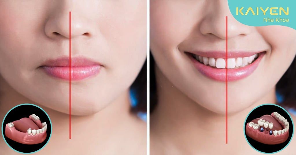 Mất răng có bị lệch mặt không? Khắc phục bằng cách nào?