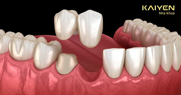 [HỎI - ĐÁP] Mất răng có bọc sứ được không? – Nha khoa Quốc tế KAIYEN