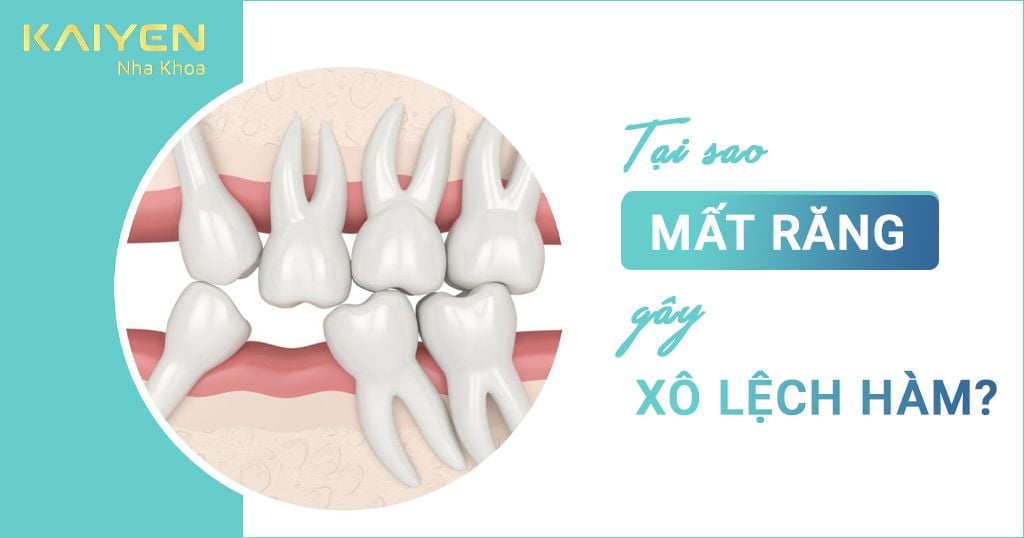 Tại sao mất răng gây xô lệch hàm? Các biến chứng và cách khắc phục?