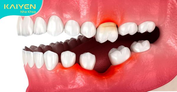 Mất răng làm trồi răng đối diện: Hậu quả và cách khắc phục
