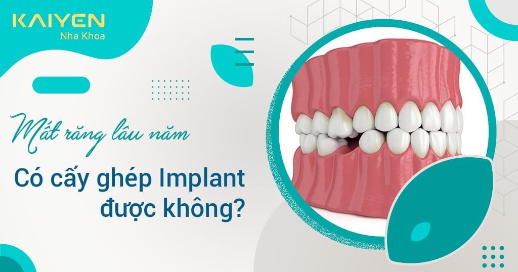 [Giải đáp] Mất răng lâu năm có cấy ghép Implant được không?