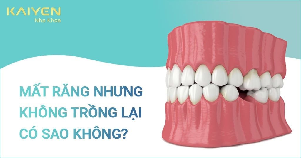 Mất răng nhưng không trồng lại có sao không? Cảnh giác biến chứng