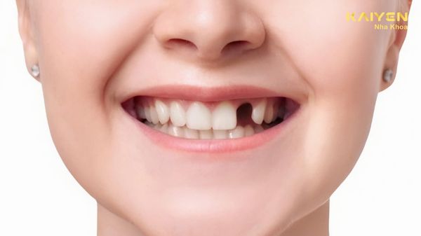 Mất răng số 2 có sao không? Cách khắc phục nào hiệu quả