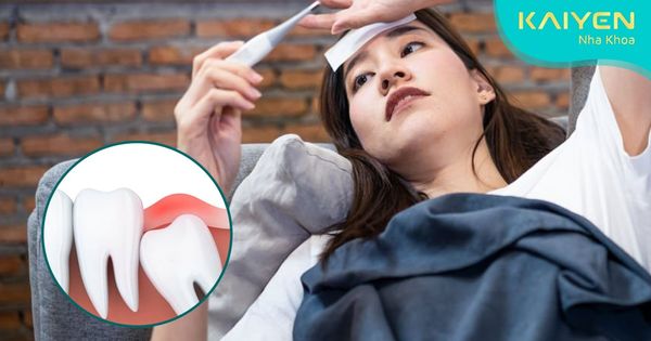 Mọc răng khôn có bị sốt không? Cách khắc phục như thế nào?