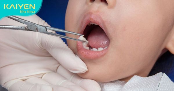 14 tuổi trồng răng được không? Giải pháp nào an toàn?
