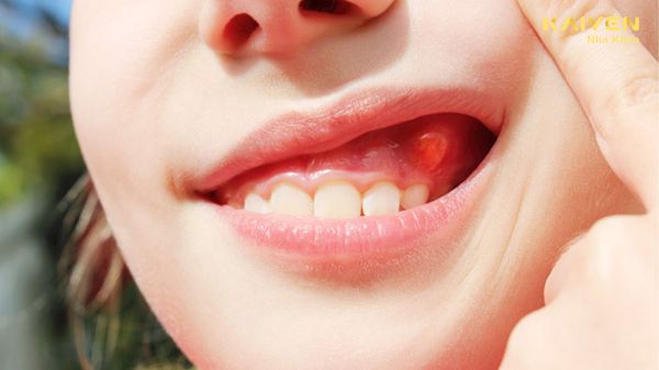 Nang thân răng là gì? Có nguy hiểm không? Cách điều trị như thế nào?