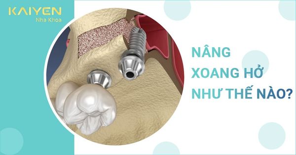 Nâng xoang hở là như thế nào? Có đau không? Cần lưu ý gì?