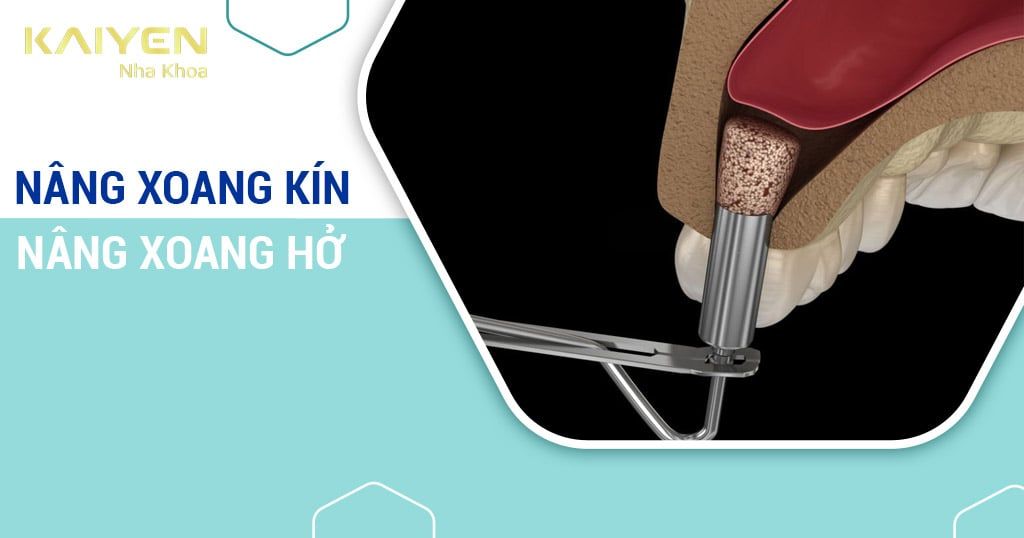 Nâng xoang kín và nâng xoang hở: Đặc điểm, quy trình, đối tượng thực hiện