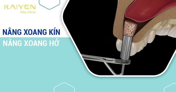 Nâng xoang kín và nâng xoang hở: Đặc điểm, quy trình, đối tượng thực hiện