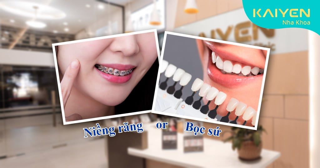 Nên niềng răng hay bọc sứ tốt hơn? Các trường hợp cụ thể