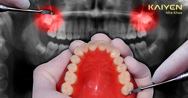 Có nên nhổ 2 răng khôn cùng lúc không? Liệu có gây nguy hiểm không?