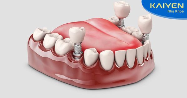 Nhổ răng bao lâu thì cấy Implant được? Thời điểm nào tốt