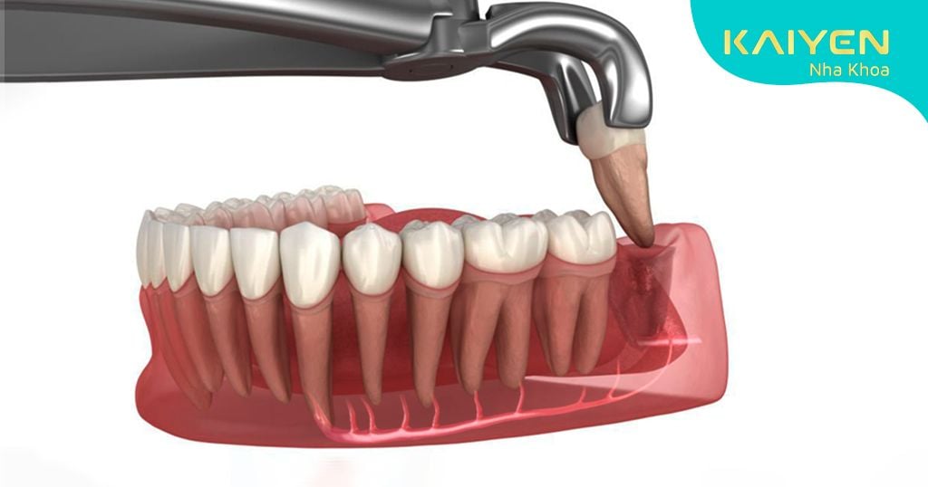 Nhổ răng khôn có chạm dây thần kinh không? Những lưu ý an toàn