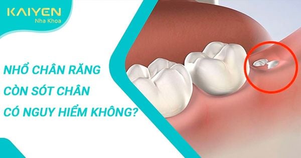 [Giải đáp] Nhổ răng khôn còn sót chân răng có nguy hiểm không?