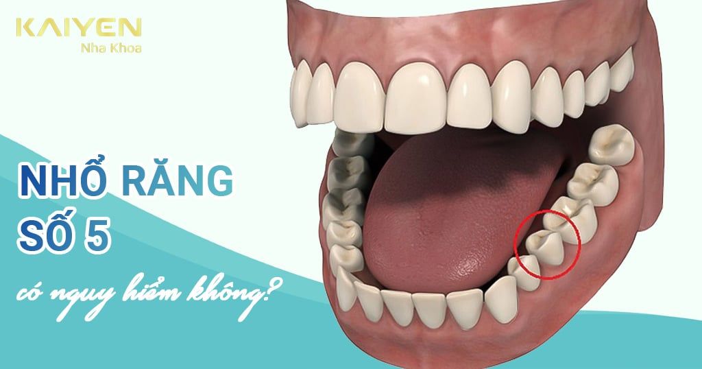 Nhổ răng số 5 hàm dưới có nguy hiểm không? Giá bao nhiêu?