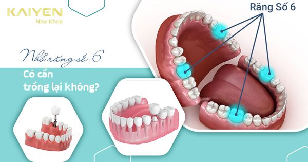 Nhổ răng số 6 có cần trồng lại không? Bao lâu thì trồng được?