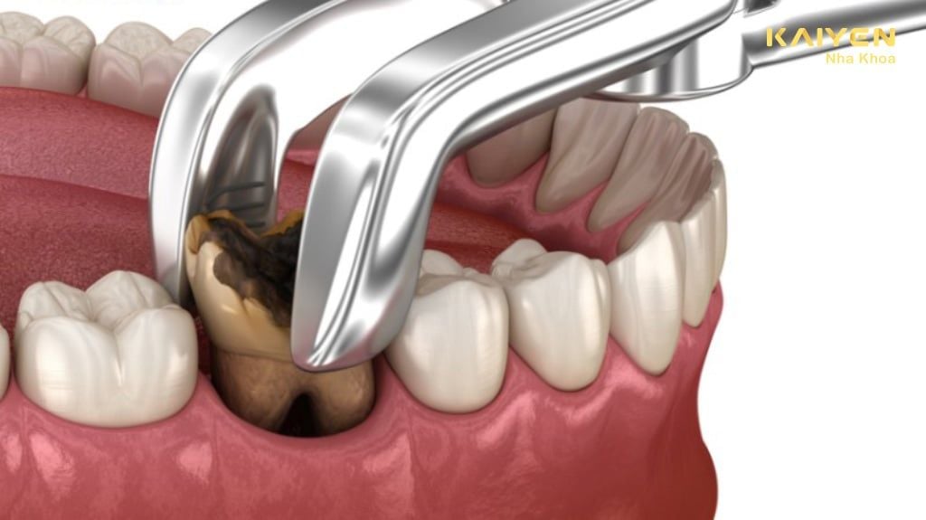 Nhổ Răng Vĩnh Viễn Có Ảnh Hưởng Gì Không? Răng Có Mọc Lại Không