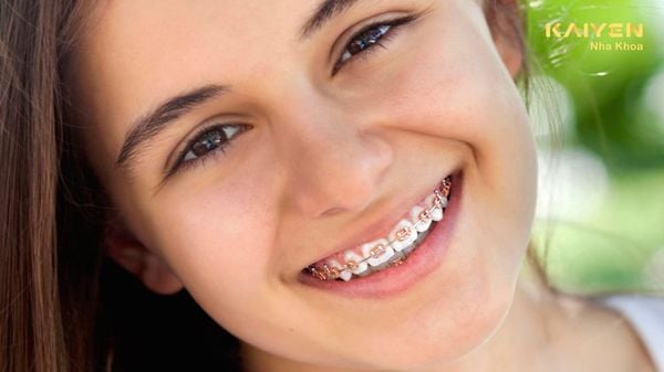 Niềng răng bị gò má cao phải làm sao? Khắc phục như thế nào?