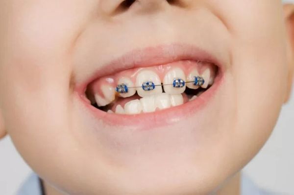 Các phương pháp niềng răng trẻ em phổ biến hiện nay