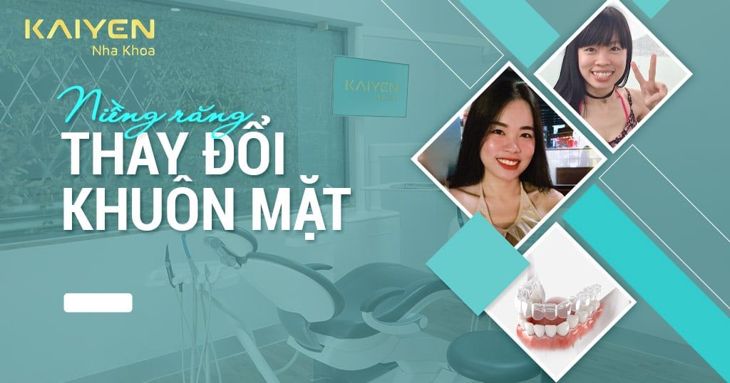 Niềng răng có làm thay đổi khuôn mặt không? 5 sự khác biệt trước và sau