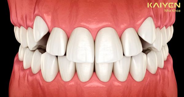 Có nên niềng răng khểnh không? Giải pháp nào tốt? Giá bao nhiêu?