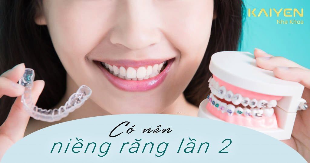 Tại sao phải niềng răng lần 2? Có nên không? Niềng mất bao lâu?