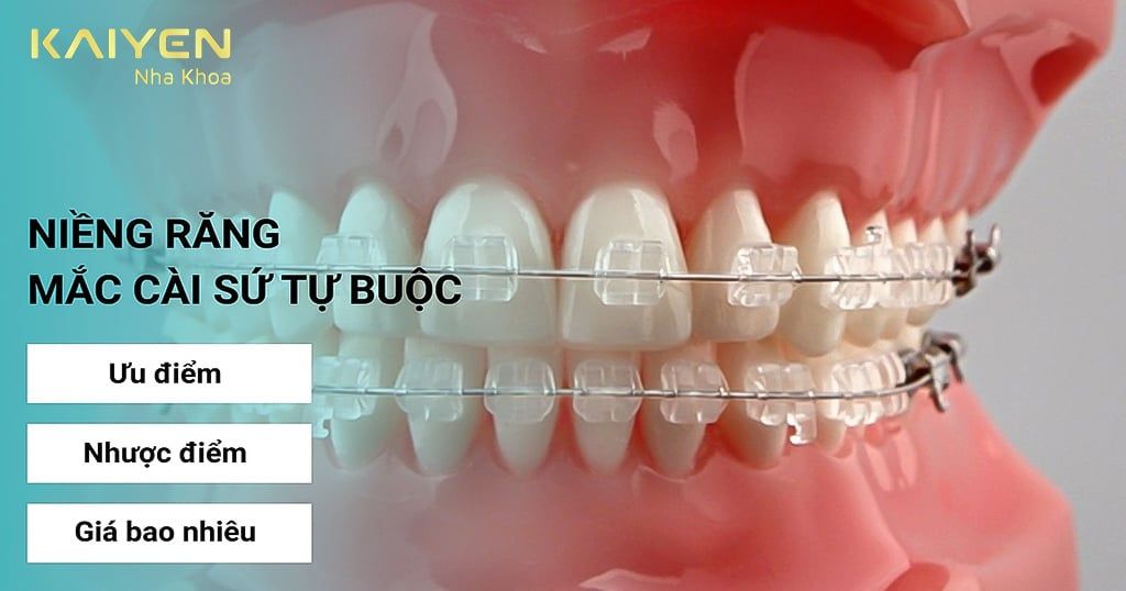Niềng răng mắc cài sứ tự buộc giá bao nhiêu? Ưu, nhược điểm