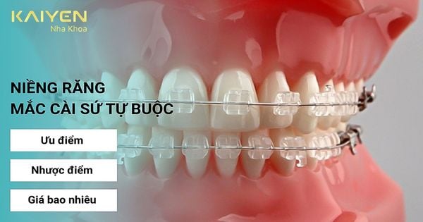 Niềng răng mắc cài sứ tự buộc giá bao nhiêu? Ưu, nhược điểm