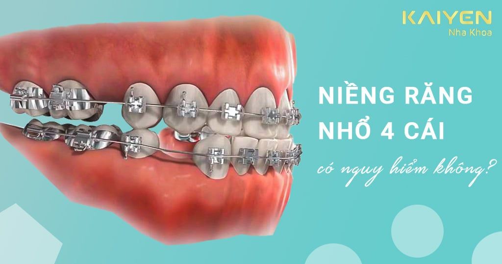 Trường hợp nào niềng răng nhổ 4 cái? Có nguy hiểm hay không?
