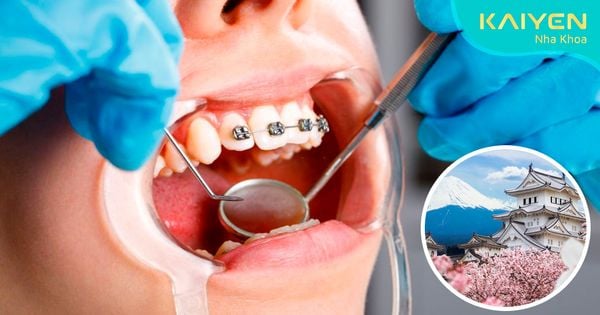 Niềng răng ở Nhật giá bao nhiêu? So với Việt Nam có đắt không?