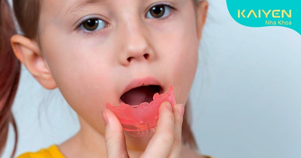 Niềng răng tháo lắp trẻ em là gì? Có mấy loại? Giá bao nhiêu?
