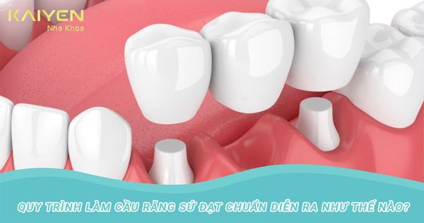 Quy trình làm cầu răng sứ đạt chuẩn an toàn và hiệu quả nhất