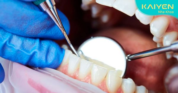 Quy trình lấy cao răng chuẩn gồm mấy bước? Thực hiện thế nào?