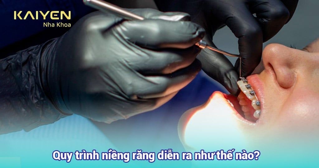 Quy trình niềng răng diễn ra như thế nào? Các bước đạt chuẩn tại KAIYEN
