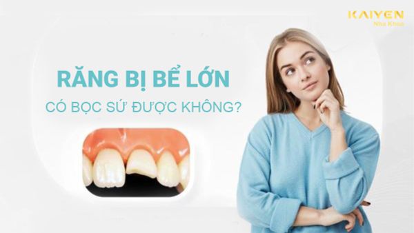 Răng bị bể lớn có bọc sứ được không? Nguyên nhân răng bị bể