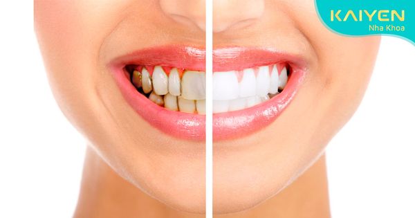 Răng nhiễm kháng sinh tẩy trắng được không? Làm sao để răng trắng sáng