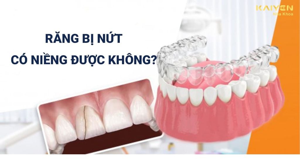 Răng bị nứt có niềng được không?