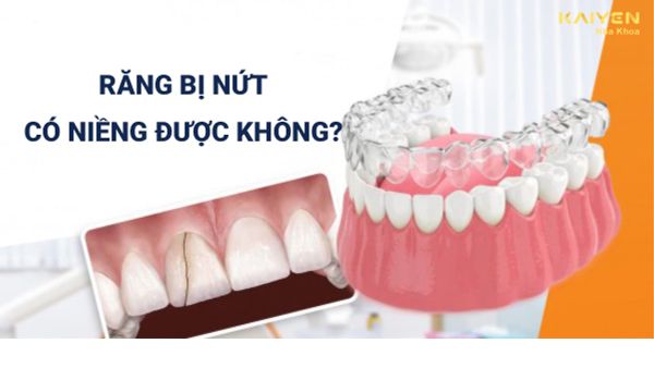 Răng bị nứt có niềng được không?